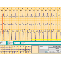 SpiderView Holter Recorder and Synecope Software - Image 4
